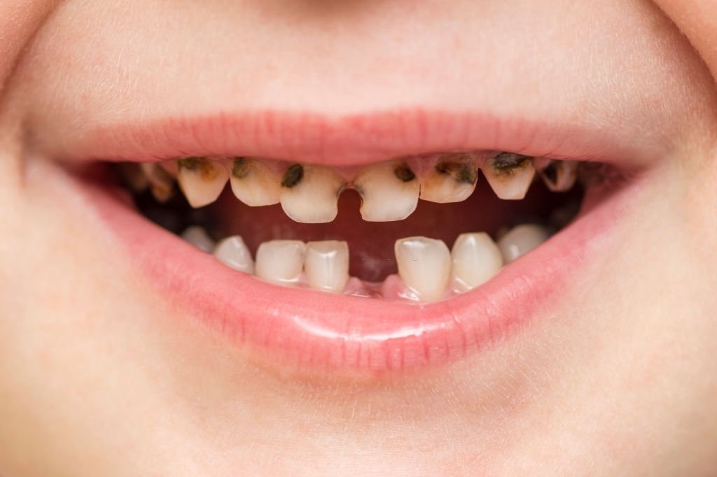 Wypadnięty Ząb – Znaczenie I Symbolika Snów 3